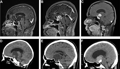 Pathological and Prognostic Characterization of Craniopharyngioma Based on the Expression of TrkA, β-Catenin, Cell Cycle Markers, and BRAF V600E Mutation